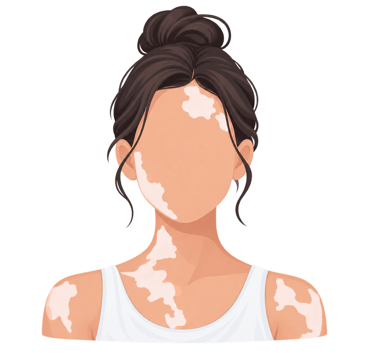 Vitiligo